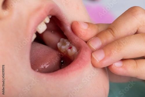 Installation of a colored red filling in a milk tooth for a child. Colored fillings in dentistry for children. Treatment of pulpitis and deep caries, close-up