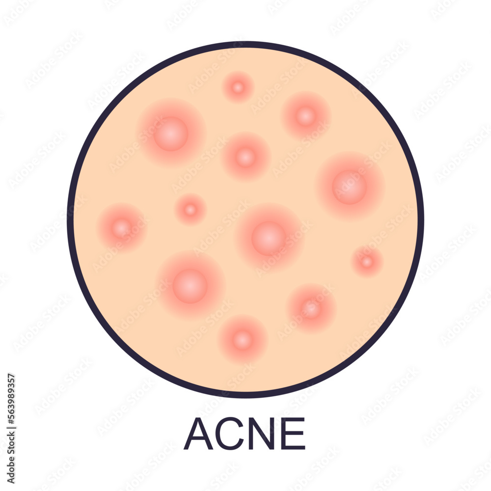 Skin acne problems vector illustration. Sign of dry or oily skin problems isolated on white background. Health, skincare concept Skin acne problems vector illustration. Sign of dry or oily skin problems isolated on white background. Health, skincare concept