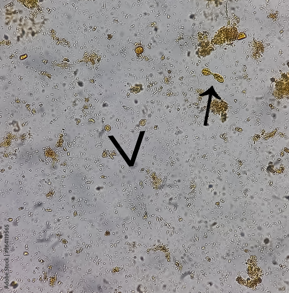 Microscopic examination of Stool showing Blastocystis hominis(Vacuolar