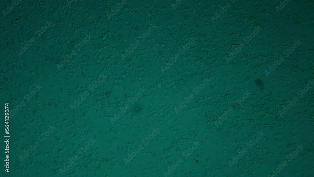 Microscopy of human lungs. Contents of pus from the lungs. Acute