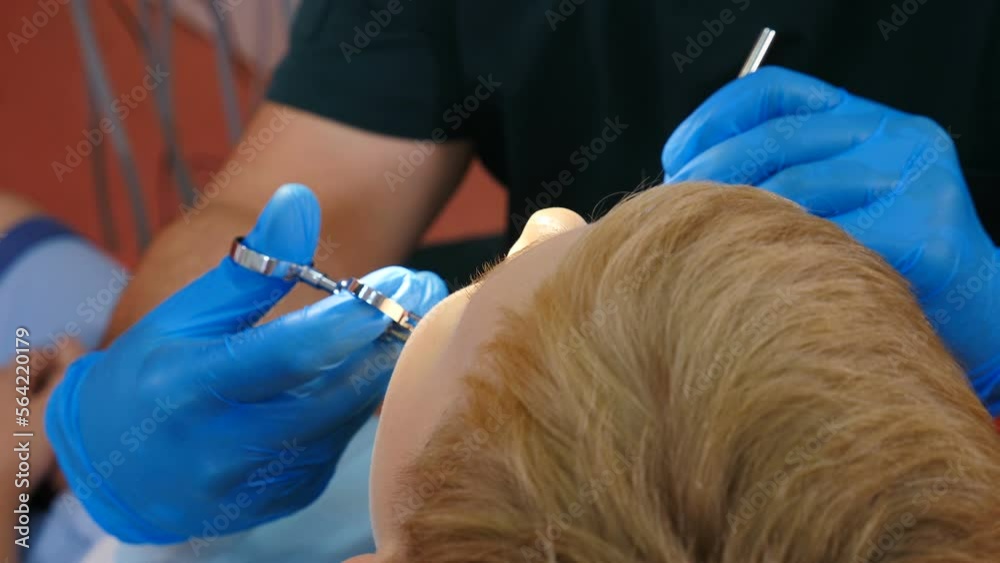 Vidéo Stock Dentist using syringe with anesthetic, making injection of