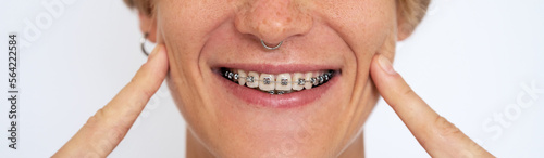 Woman with health smile showing white teeth with dental braces.
