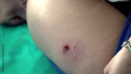 Caucasian woman's leg with a dog bite wound. Female leg with bite marks from a dog and a large bruise photo