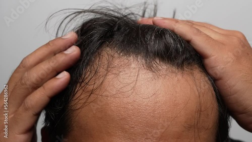 Asian man scratching his head with hoary hair, hair loss, hair breakage and frizzy hair problem, close up.