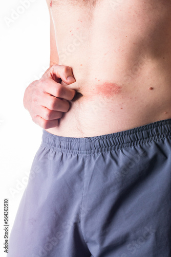The first signs of psoriasis or another skin disease.