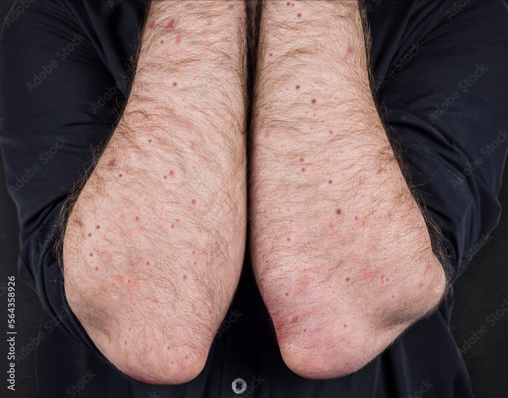 Measles. Viral disease of immunodeficiency dermatitis rash on the body