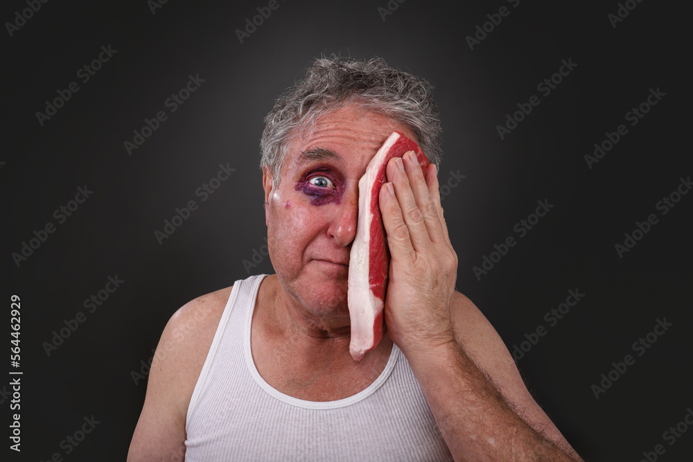 © soupstock - Man with an bruised black eye putting steak on his face to reduce swellling