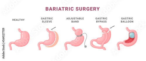 Bariatric surgery types information medical scheme vector isometric illustration