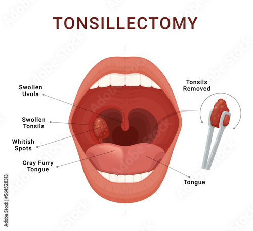 Tonsillectomy scheme removal of palatine tonsils acute pharyngitis vector isometric illustration photo