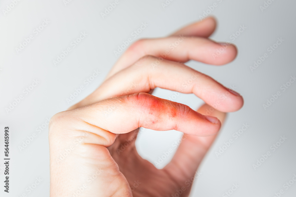 Chilblains in hands. Sensitive skin to cold and damp. Dermatological care of joints and sensitive skin. Red spots and swelling on the fingers. Chilblains in hands. Sensitive skin to cold and damp. Dermatological care of joints and sensitive skin. Red spots and swelling on the fingers.