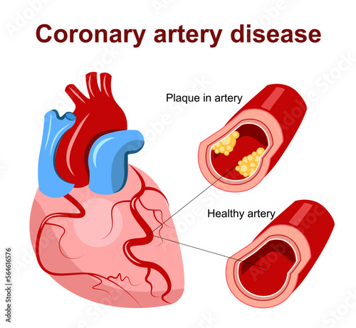 Coronary artery disease. Atherosclerosis. Cholesterol plaque