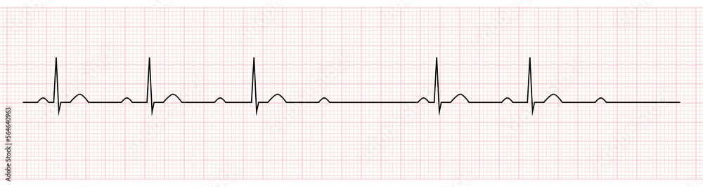 EKG Showing second degree av block mobitz I