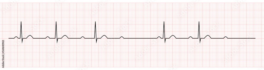 EKG Showing second degree av block mobitz I EKG Showing second degree av block mobitz I