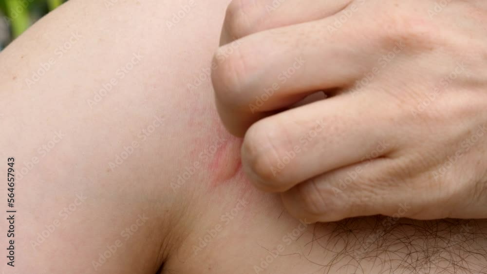 Man scratching a swollen, red insect bite on chest Man scratching a swollen, red insect bite on chest