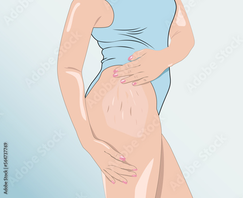 illustration. A woman after weight loss shows stretch marks on the skin of her legs and the outer and inner side of the thighs. Treatment of skin stretch marks in the clinic.