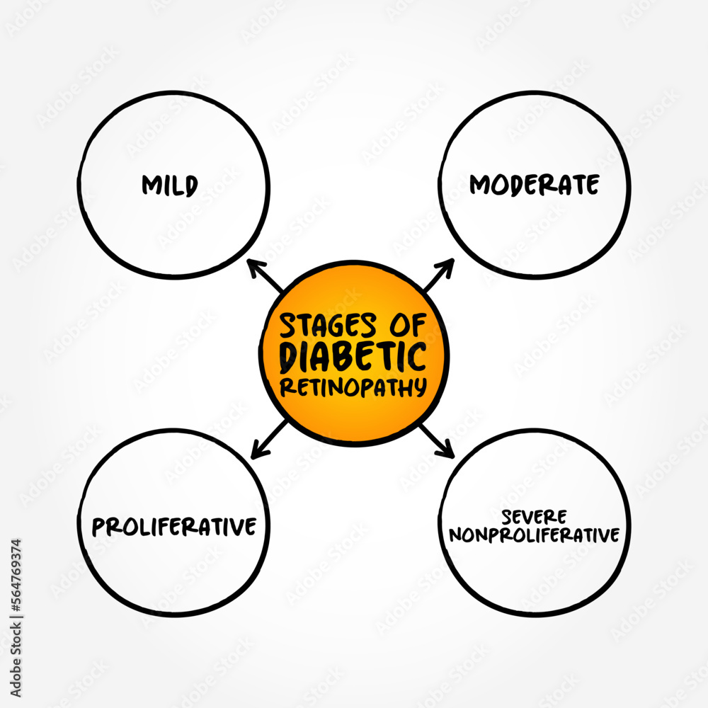 Stages of diabetic retinopathy (diabetes complication that affects eyes ...