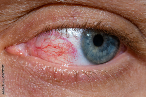 Przekrwione czerwone oko z widocznymi żyłkami  photo
