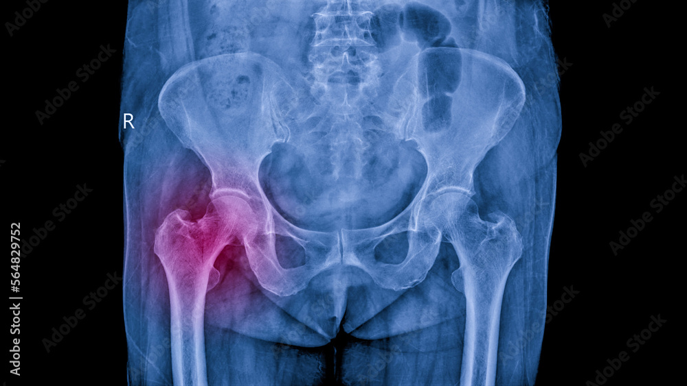 Photo of plain radiograph on dark background in hospital.The film use for diagnosis the illness of patient.Medical concept.X ray shown Non displace fracture of femoral neck in osteoporosis woman. Photo of plain radiograph on dark background in hospital.The film use for diagnosis the illness of patient.Medical concept.X ray shown Non displace fracture of femoral neck in osteoporosis woman.