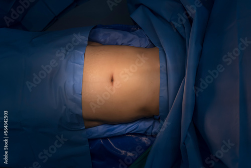 Preparation of the Abdomen before Laparoscopic Abdominal Surgery.Aseptic technique for set up patient before laparotomy.Surgeon prepare inside operating theatre.Medical and insurance concept.