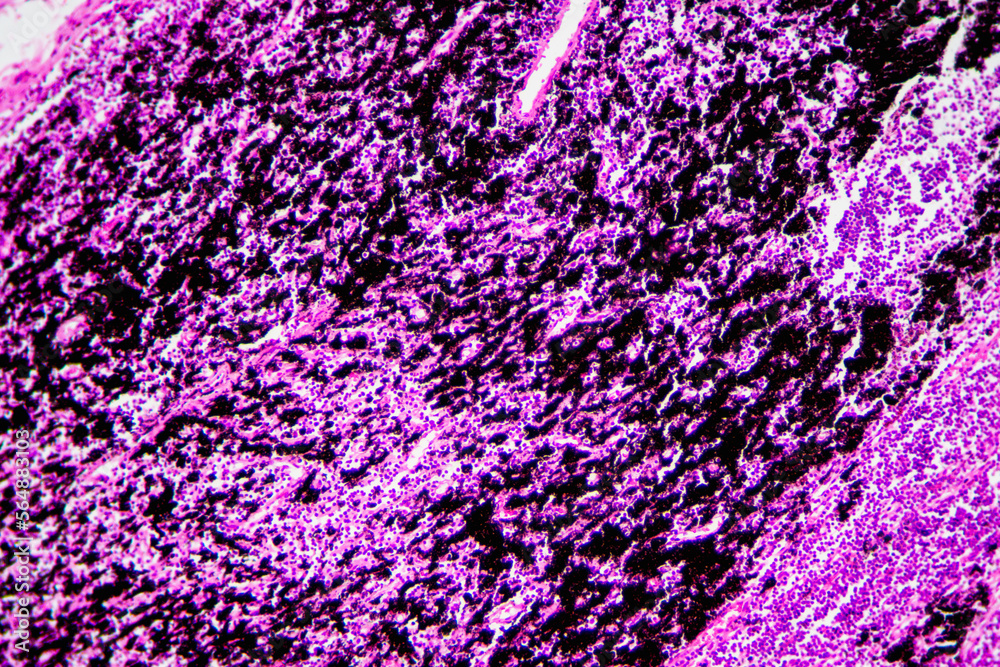 Chronic bronchitis disease human cells Chronic bronchitis disease human cells