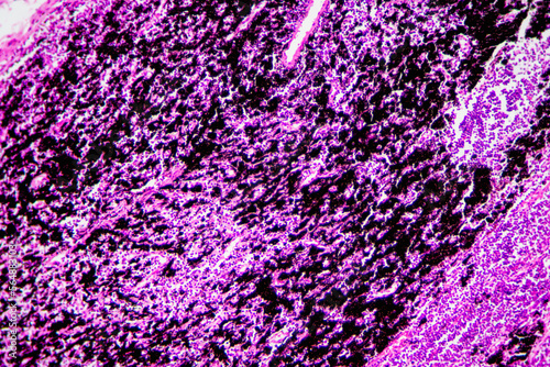 Chronic bronchitis disease human cells