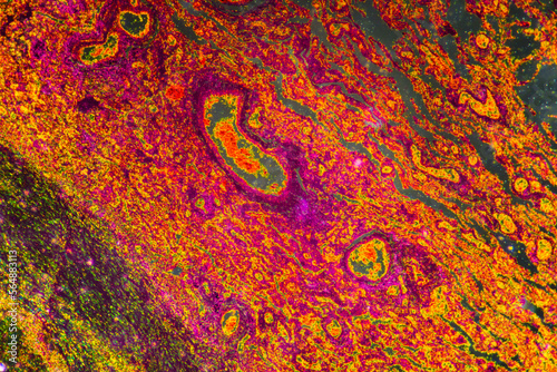 Chronic bronchitis disease human cells