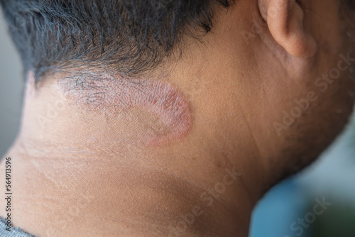 Dark-skinned Asian men suffer from scalp dermatitis due to moisture-causing fungi. fungal itching. skin diseases-allergies, psoriasis, eczema, dermatitis.