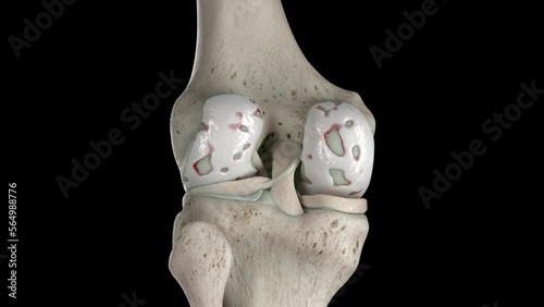 3D rendered medical animation of damaged knee cartilage