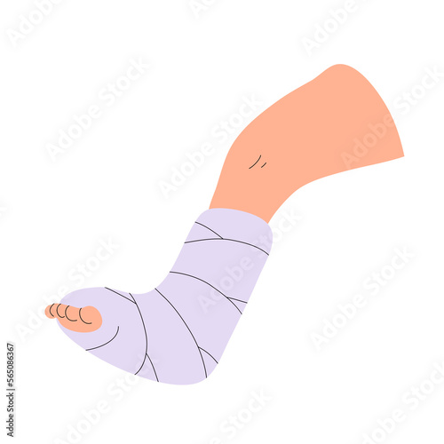 Leg fracture. Gypsum bandage. Medical care, treatment and rehabilitation. Help with trauma. Flat vector illustration isolated on white background