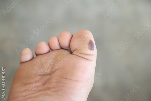 bruise wound of blood at thumb of foot from walking too much in daily life. health care concept photo. © Apiwat