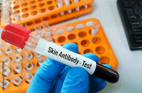 Scientist hand holding blood sample for Skin Antibody test.