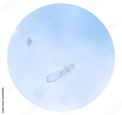 Schistosoma Haematobium Parasite in human urine specimen under microscope. Urinary parasite photo