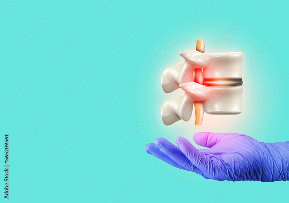 Spinal herniation, herniated disc. Low back pain. Spine. Intense disc