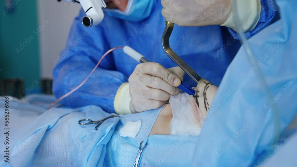 Surgeon preparing cavity in patient’s breast for the future implant. Doctor holds the breast skin with a tool and uses electric instrument. Surgeon preparing cavity in patient’s breast for the future implant. Doctor holds the breast skin with a tool and uses electric instrument.