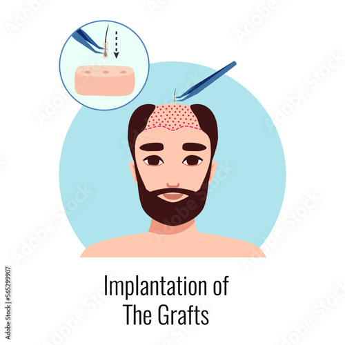Male Alopecia Implantation Composition