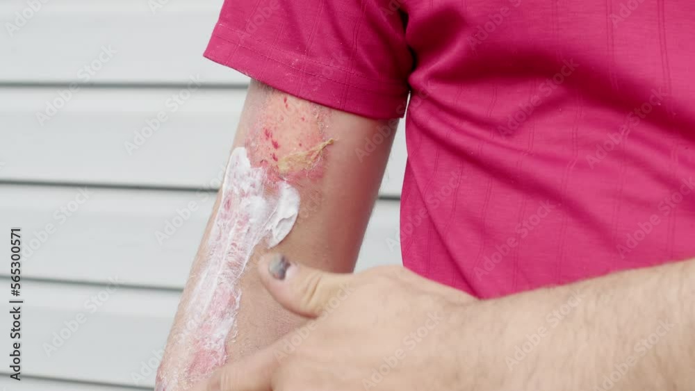 Faceless man rubs ointment on wound on his arm outdoor. Guy in T-shirt applies medicine with his fingers to bruised, peeled place. Unrecognizable boy spreads salve over burnt skin. Treatment, healing Faceless man rubs ointment on wound on his arm outdoor. Guy in T-shirt applies medicine with his fingers to bruised, peeled place. Unrecognizable boy spreads salve over burnt skin. Treatment, healing