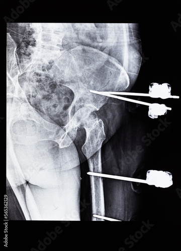 x-ray with external fixation device fixed in femur and pelvic bones photo