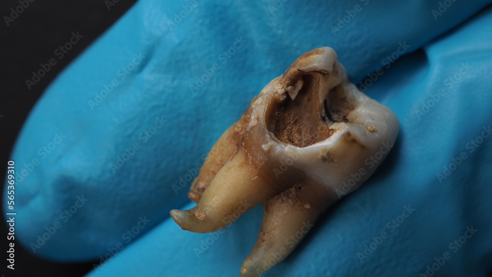 Tooth decay and dentist hand with glove and black background. Macro ...