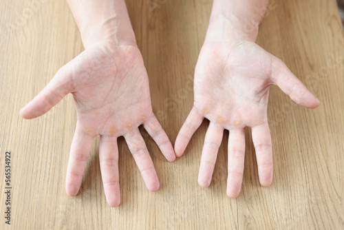 Many calluses on distal palmar surface of hands.