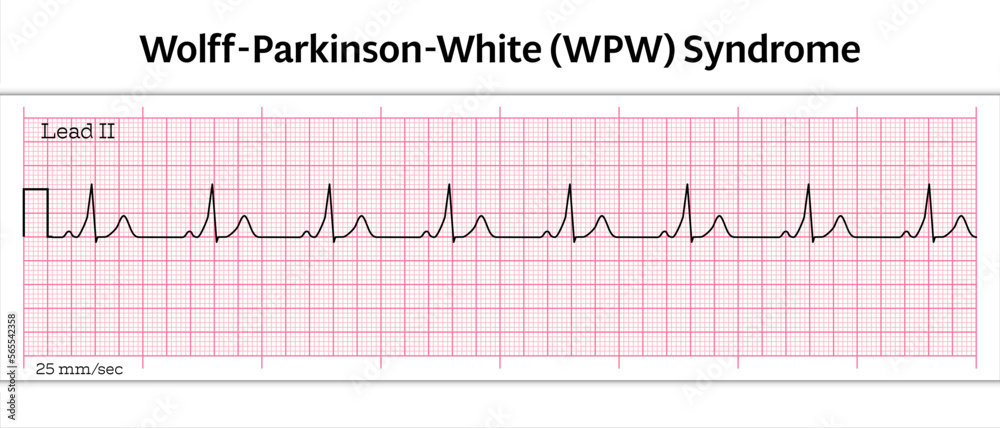 ECG Wolff-Parkinson-White (WPW) Syndrome - 8 Second ECG Paper - Vector Medical Illustration ECG Wolff-Parkinson-White (WPW) Syndrome - 8 Second ECG Paper - Vector Medical Illustration