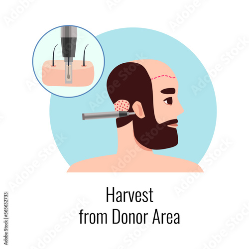 Male Alopecia Donor Composition