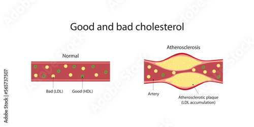 Good and bad cholesterol. LDL and HDL.