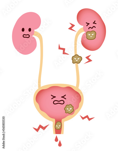 尿路結石でつらそうな腎臓と膀胱のイラスト photo
