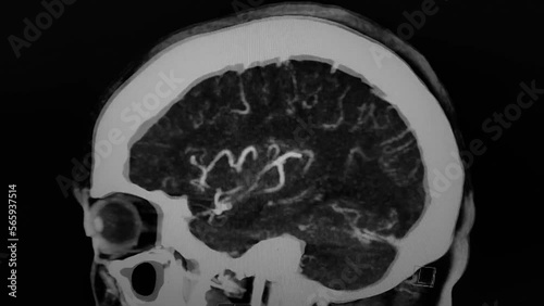 CT Brain angiography - sagittal image in black, white photo