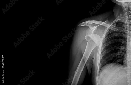 Photo of plain radiograph on dark background in hospital. The film use for diagnosis the illness of patient.Medical concept. Fracture proximal humerus arm in osteopenia patient. Elderly broken bone. photo
