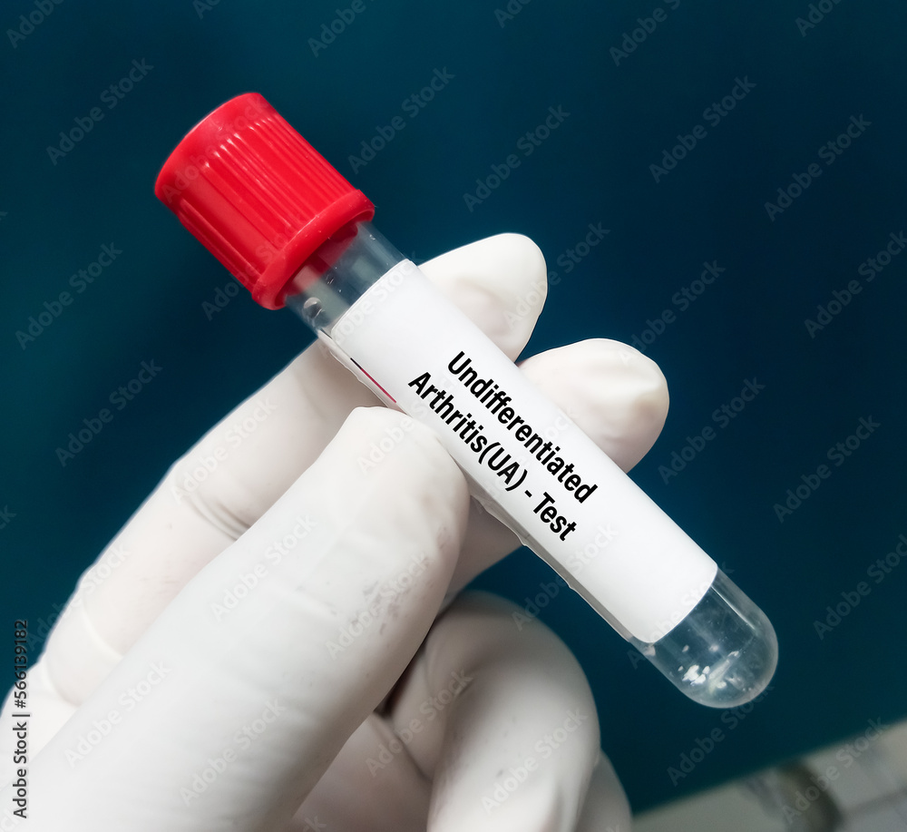 Synovial fluid analysis for Undifferentiated arthritis (UA) or Non