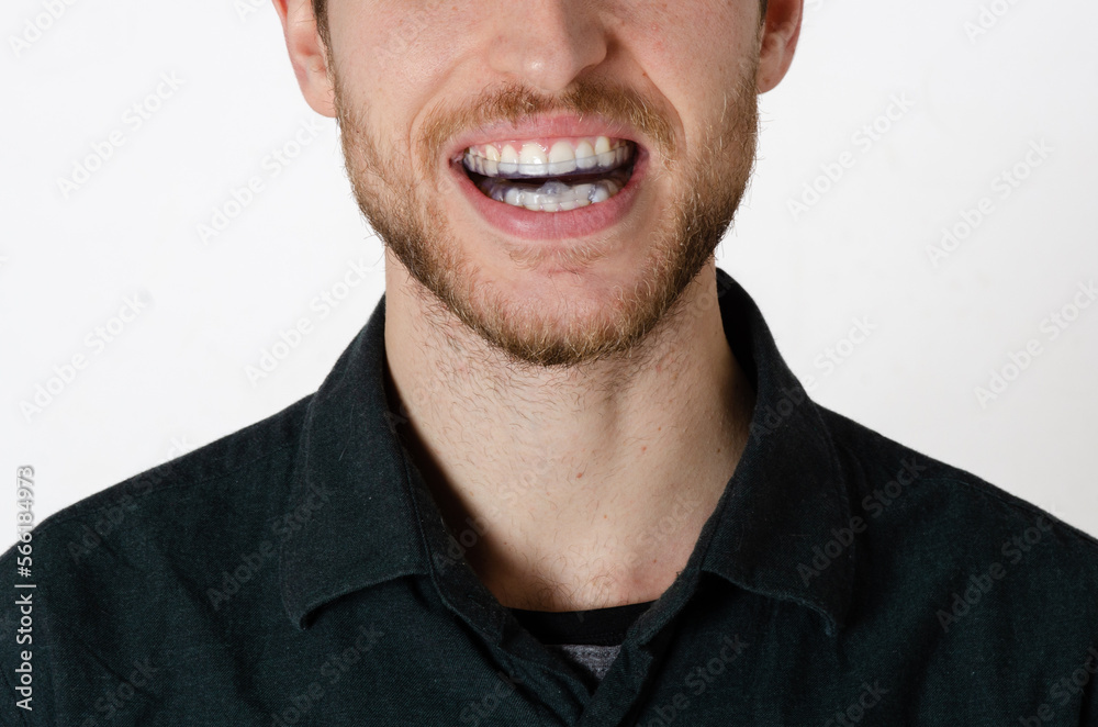 Man smiling with transparent silicone aligner for orthodontics. Concept of dentist, orthodontic treatment and pretty smile. Background isolated on white background Man smiling with transparent silicone aligner for orthodontics. Concept of dentist, orthodontic treatment and pretty smile. Background isolated on white background