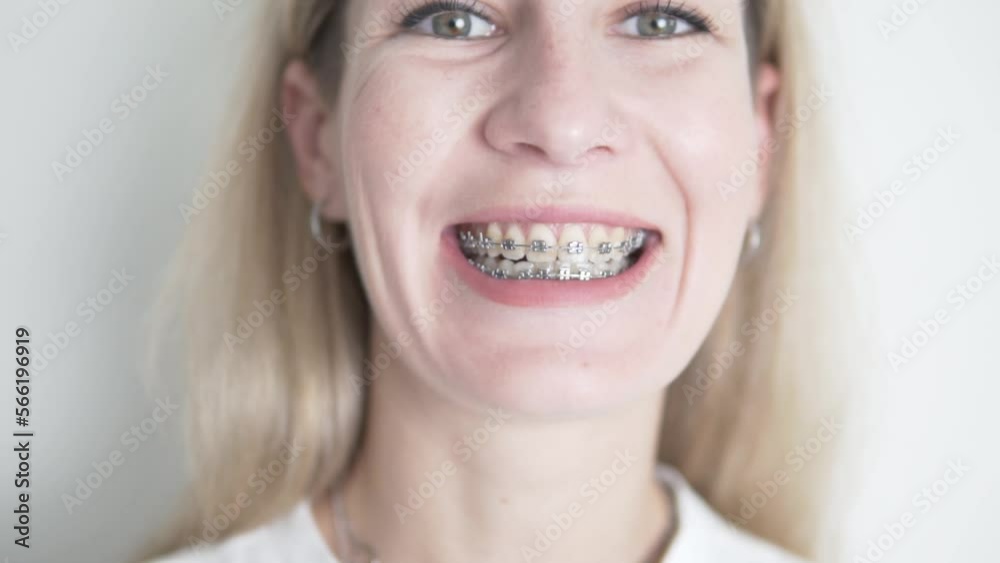 A close-up of the face of a girl in braces smiles broadly A close-up of the face of a girl in braces smiles broadly