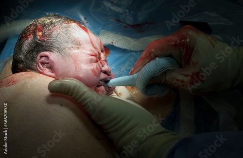 Asian baby born via c-section