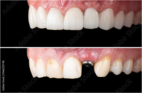 emax ceramic crowns and veneers photo